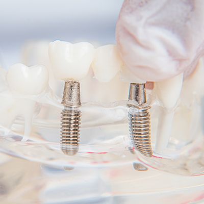 골융합이 완료된 임플란트 픽스처 모형과 크라운 보철물