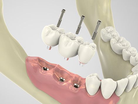 디지털 가이드 임플란트 - 3D 스캔 데이터를 기반으로 시뮬레이션된 임플란트 식립 위치 모형